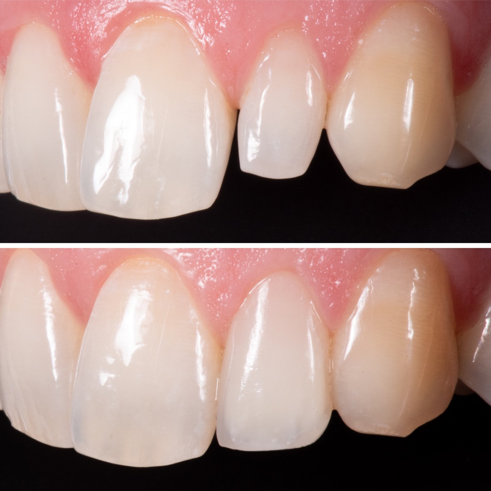 Composite Restorations / Fillings