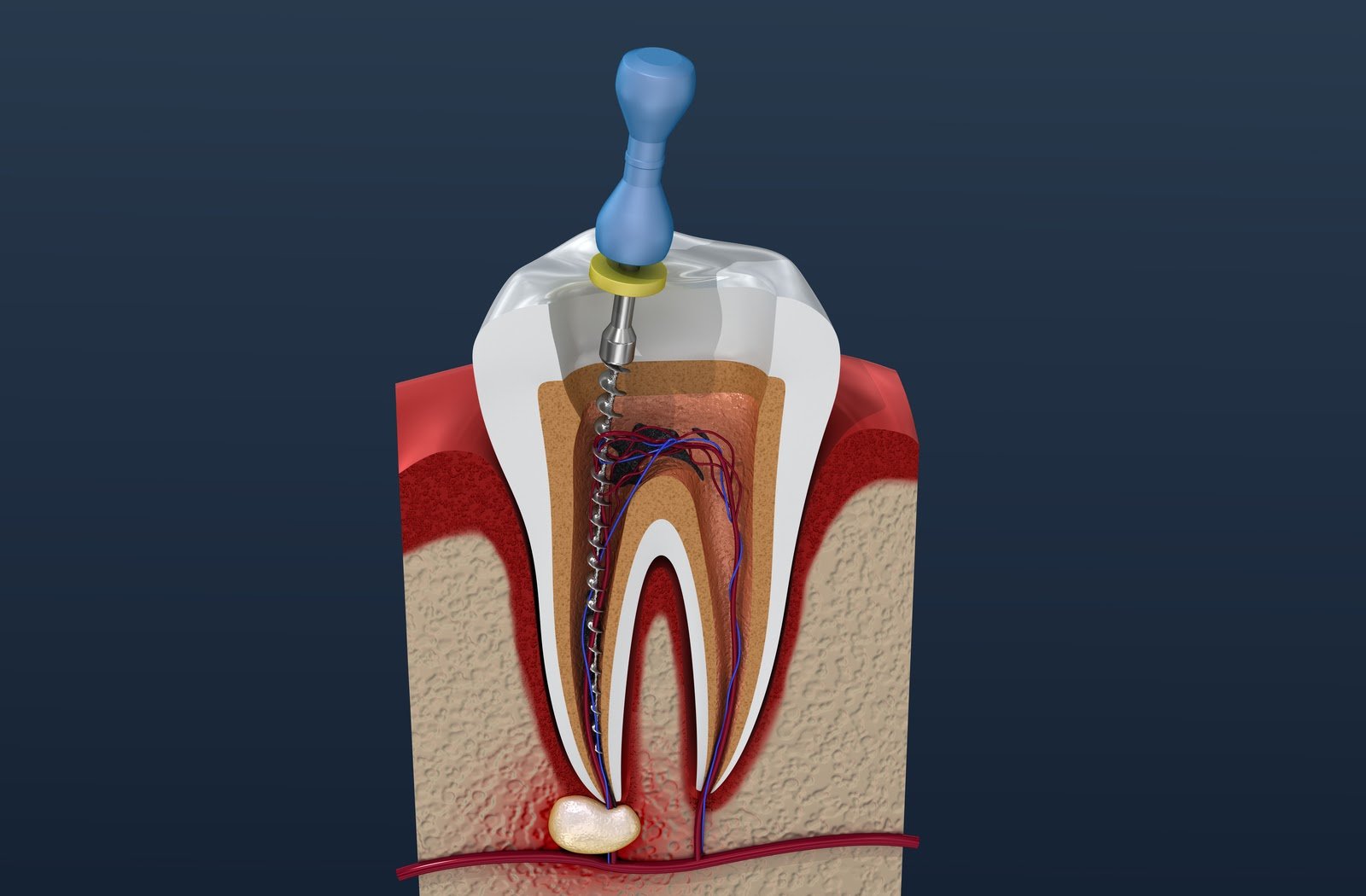 Root Canals
