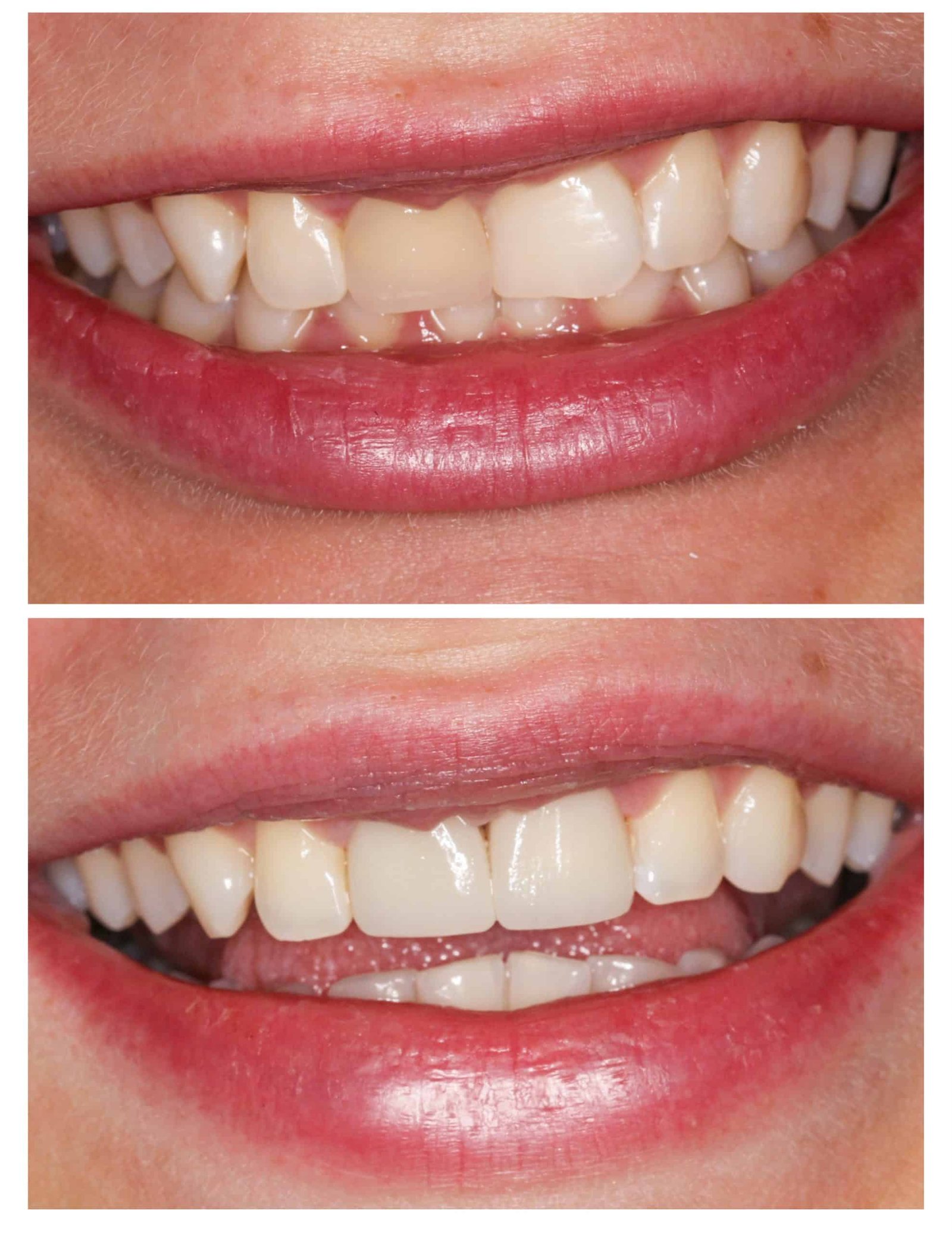 Veneers and Crowns